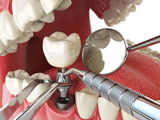 Best Emergency Root Canal Treatment in Mason, OH